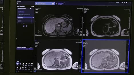 Tomografía-de-cerebro-en-la-exploración-de-MRI.