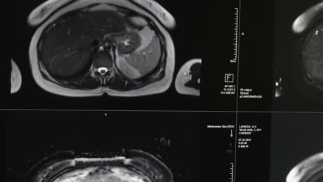 Gehirn-Tomographie-auf-professionelle-medizinische-Ausrüstung-MRT-Untersuchung.