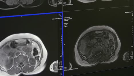 Tomografía-de-cerebro-en-MRI-exploración-equipo-médico-profesional.