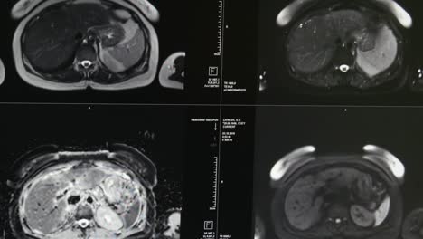 Tomografía-de-cerebro-en-la-exploración-de-MRI.