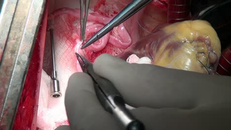 Heart-with-surgical-thread-on-live-organ-of-patient-during-operation-in-clinic.