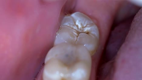 dientes-con-caries-en-la-boca-de-un-hombre,-primer-plano