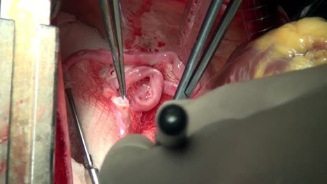 Herz-mit-dem-chirurgischen-Faden-live-Organ-des-Patienten-während-des-Betriebs-in-Klinik.