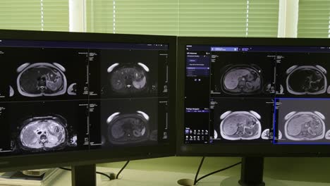 Tomografía-de-cerebro-en-la-exploración-de-MRI.