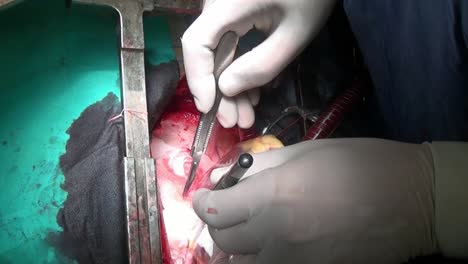 Heart-surgery-on-live-organ-of-patient-in-hospital.