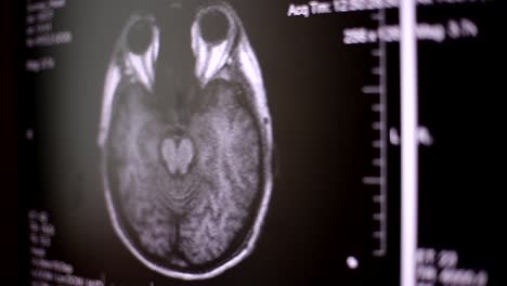 Blick-auf-Computer-Bildschirm-beim-Patienten-bewegt-sich-in-MRT-Gerät-Arzt,-analysiert-der-Arzt-die-Ergebnisse-der-Kernspintomographie-auf-seinem-Laptop.-4k,-Hintergrund-unscharf