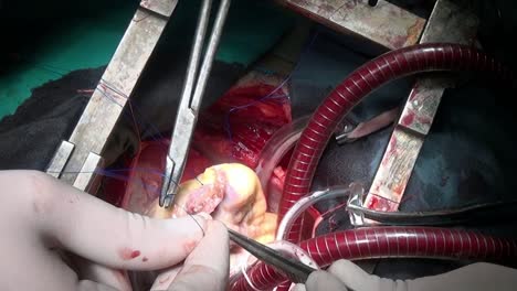 Heart-with-surgical-thread-during-operation-on-live-organ-of-patient-in-clinic.