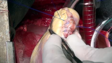 Heart-with-surgical-thread-on-live-organ-of-patient-during-operation-in-clinic.