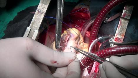 Heart-with-atraumatic-suture-material-surgical-thread-during-operation.