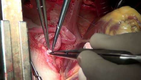 Heart-with-surgical-thread-on-live-organ-of-patient-during-operation-in-clinic.