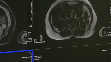 Tomografía-de-cerebro-en-la-exploración-de-MRI.