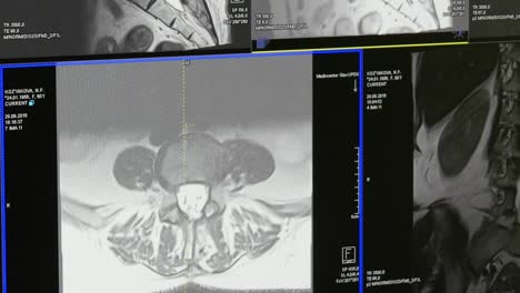 Spinal-cord-and-spinal-column-tomography-on-MRI-scan.