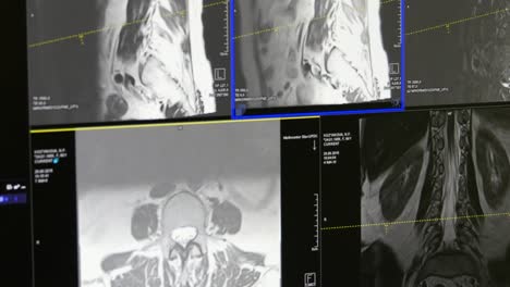 Spinal-cord-and-spinal-column-tomography-on-MRI-scan.