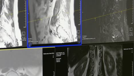 Spinal-cord-and-spinal-column-tomography-on-MRI-scan.