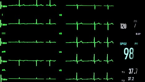 Pulso-del-corazón-en-el-monitor