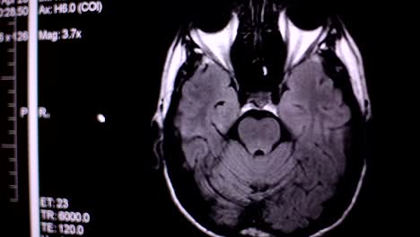 Blick-auf-Computer-Bildschirm-beim-Patienten-bewegt-sich-in-MRT-Gerät-Arzt,-analysiert-der-Arzt-die-Ergebnisse-der-Kernspintomographie-auf-seinem-Laptop.-4k,-Hintergrund-unscharf