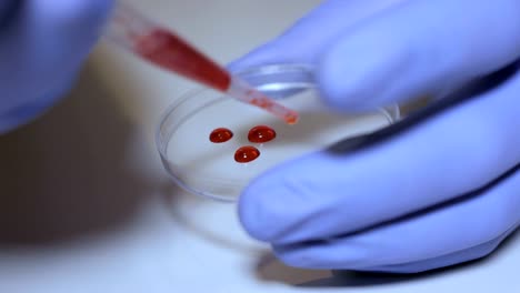 Técnico-de-laboratorio-manteniendo-la-pipeta-y-muestras-de-sangre-en-sala-del-hospital-para-transfusión-de-sangre,-las-manos-cerca-para-arriba.-Closeup-de-médico-sosteniendo-el-tubo-de-ensayo-de-la-sangre.-SIDA-/-VIH-Hospital-prueba-de-sangre.