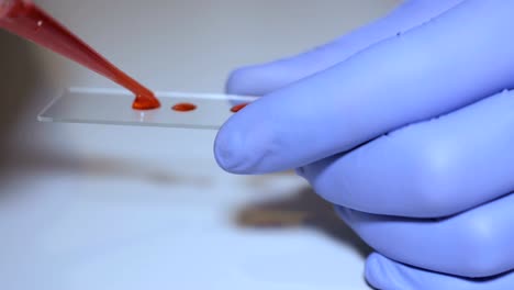 Laborantin-holding-Pipette-und-testen-Blutproben-auf-Krankenstation-für-Bluttransfusion,-Hände-schließen-sich.-Nahaufnahme-des-Arztes-hält-Reagenzglas-des-Blutes.-AIDS-/-HIV-Krankenhaus-Blut-Test.