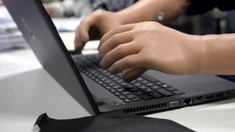 Person-with-hand-bionic-prostheses-is-typing-on-laptop-at-laboratory-table