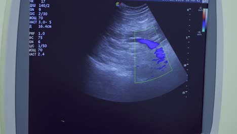 Screen-of-ultrasound-equipment