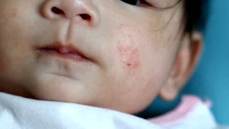 gesunde-Pflege-Baby-allergische-Dermatitis-auf-Gesichtshaut-reizen