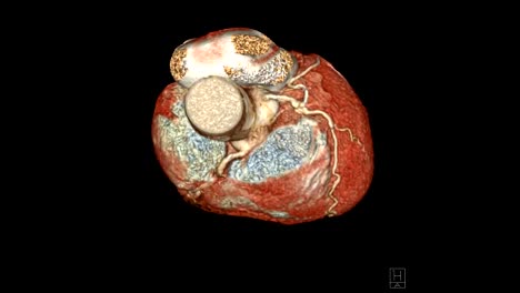 CTA-Koronare-Arterie-3D-Rendering-Bild-drehen-sich-auf-dem-Bildschirm-für-die-Diagnose-der-Gefäß-koronare-ArterieStenose-.