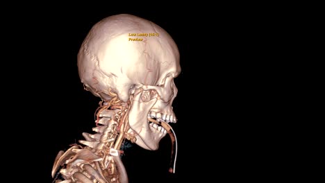 CTA-Brain-or-computed-tomography-angiography-of-the-brain-3D-Rendering-image-with-endotracheal-tube.