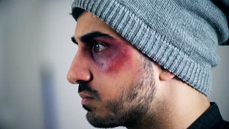 Profile-of-a-young-man-injured-in-his-face,-close-up