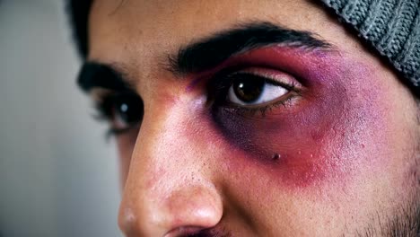 young-man-injured-in-his-face,-close-up