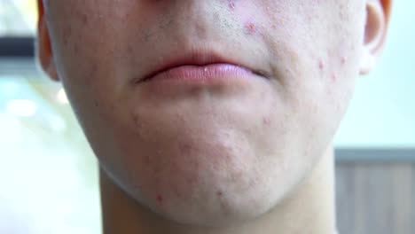 A-young-man-with-pimples-on-his-face-eats-french-fries.