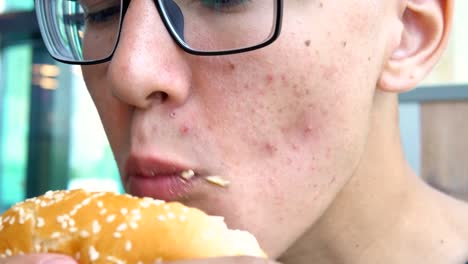 Un-hombre-joven-con-acné-en-su-cara-come-hamburguesa.