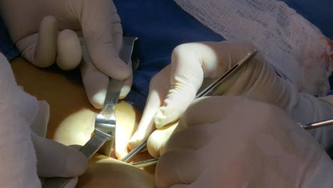 Surgeon-doing-surgical-suture-or-stitches-on-chest-after-removing-cartilage-for-nasal-septum-deviation-and-rhinoplasty-surgery-on-female-patient.-Female-patient-under-general-anesthesia.