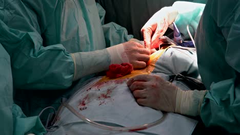 Médicos-del-operador-hacer-cirugía-a-corazón-abierto-Closeup-de-arteria-coronaria-bypass-cirugía-del-injerto.