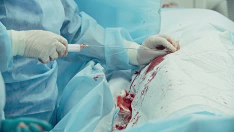 Coronary-Surgery