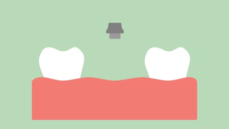 implantes-dentales,-proceso-de-instalación-y-cambio-de-los-dientes