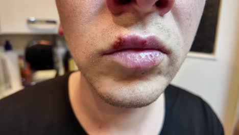 Herpes-Auf-Den-Männlichen-Lippen-Makro.-Erkältungen.-Nahaufnahme