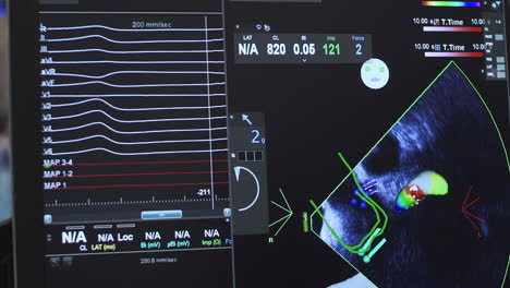 Patient-Echocardiogram-on-Monitor-in-Cardiology-Department,-Hearth-Health,-4K