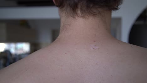 Scar-on-a-man's-back