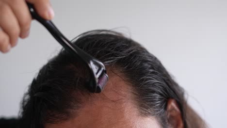man-using-roller-hair-on-his-scalp-to-prevent-baldness,-Patchy-hair-loss