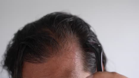 man-using-roller-hair-on-his-scalp-to-prevent-baldness,-Bald-patches