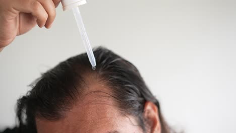 Mann,-Der-Minoxidil-Mit-Einer-Pipette-Ins-Haar-Einträgt,-Kahlheit,-Alopezie