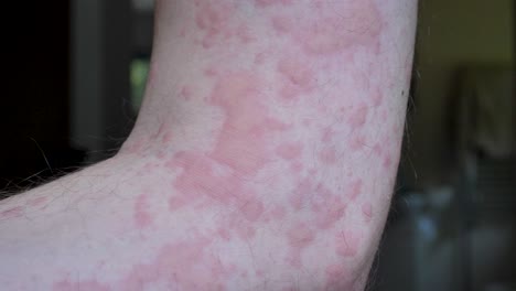 Cerca-Del-Brote-De-Urticaria-En-El-Brazo-Del-Hombre-Caucásico