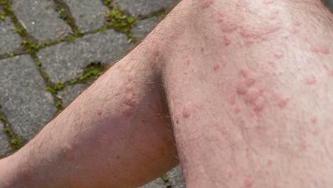 Close-up-of-hives-spreading-across-Caucasian-man's-legs