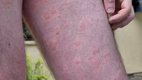 Outbreak-of-hives-on-caucasian-mans-legs