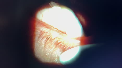 Medical-scope-view-of-meibomian-gland-expression-in-doctor's-office