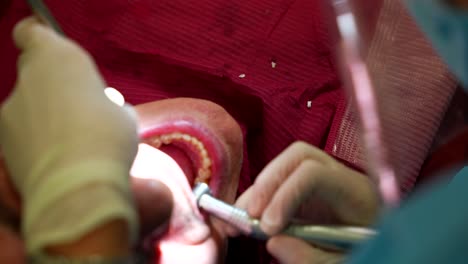 Dentist-working-on-a-patient's-teeth-with-an-assistant-using-tweezers-in-a-dental-clinic