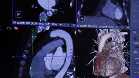Heart-Scan-Results,-Camera-Panning-Across-Computer-Monitor---4K-UHD