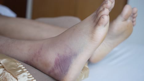 Close-up-of-women-feet-with-swelling