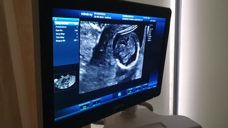 Fetal-Ultrasound-screen-showing-baby-in-womb