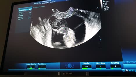 Fetal-Ultrasound-screen-showing-baby-in-womb